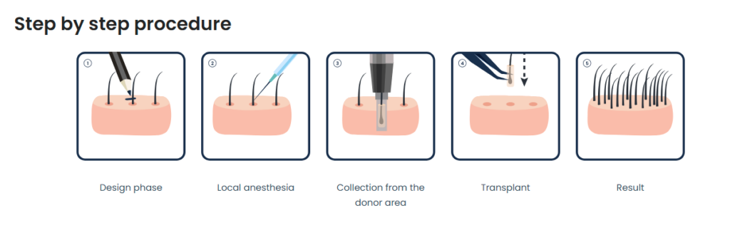 Trapianto di capelli FUE in 5 fasi, dalla fase di progettazione al risultato finale